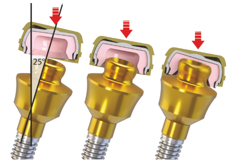 Straight Paltop Equator Abutment Conical