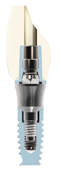 full image paltop implants single unit abutment