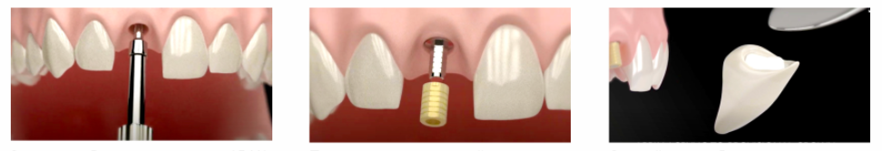 Temporary Titanium Abutment