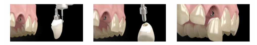 Temporary Titanium Abutment